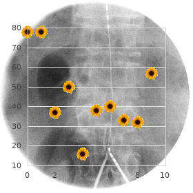 Sketetal dysplasia coarse facies mental retardation