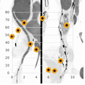 Thoracolaryngopelvic dysplasia