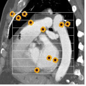 Sixth nerve palsy