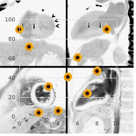 Hashimoto Pritzker syndrome