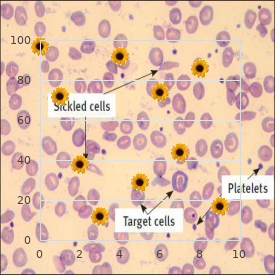 Acute myeloblastic leukemia, minimally differentiated