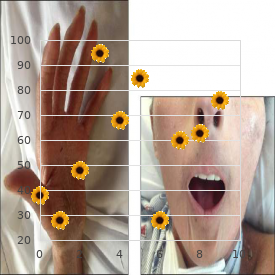 Chands syndrome